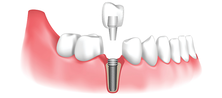 dental implants in London Ontario